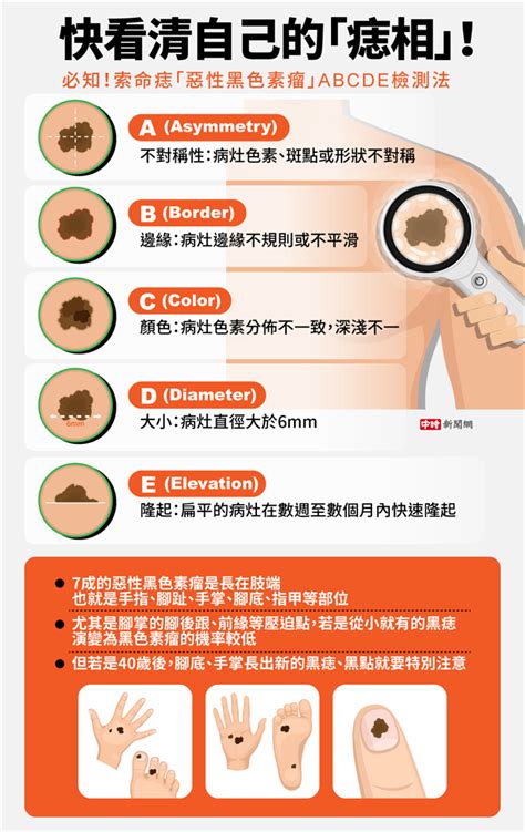 腳背黑斑|你會檢查自己的腳底嗎？醫師公開：手掌、腳底長了「。